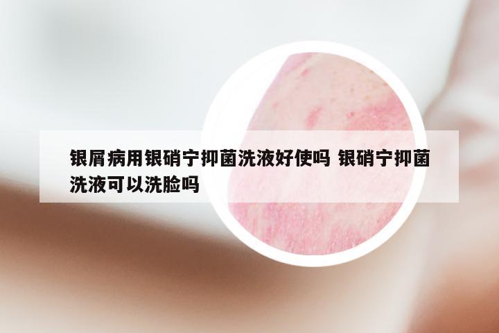银屑病用银硝宁抑菌洗液好使吗 银硝宁抑菌洗液可以洗脸吗