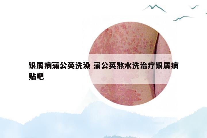 银屑病蒲公英洗澡 蒲公英熬水洗治疗银屑病贴吧