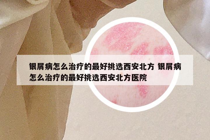银屑病怎么治疗的最好挑选西安北方 银屑病怎么治疗的最好挑选西安北方医院