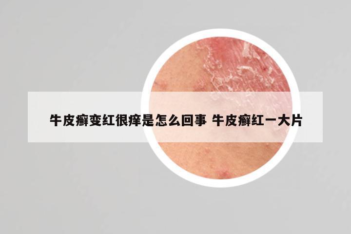 牛皮癣变红很痒是怎么回事 牛皮癣红一大片