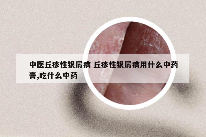 中医丘疹性银屑病 丘疹性银屑病用什么中药膏,吃什么中药