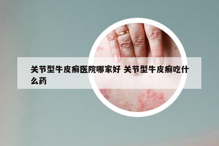 关节型牛皮癣医院哪家好 关节型牛皮癣吃什么药