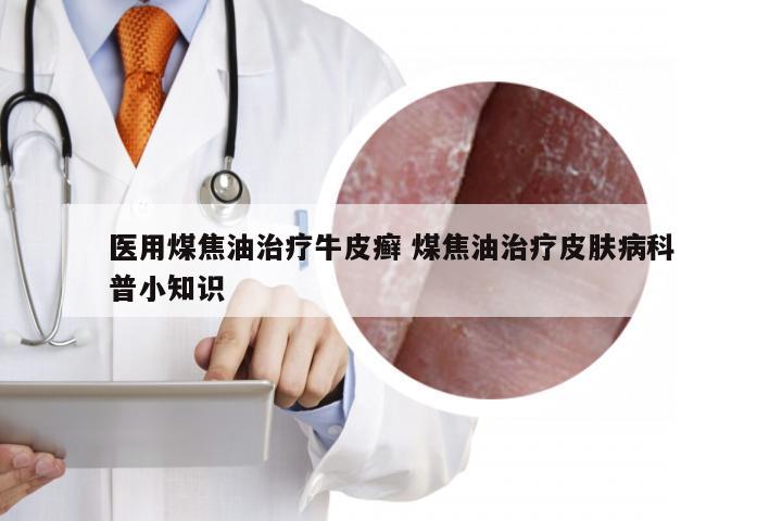 医用煤焦油治疗牛皮癣 煤焦油治疗皮肤病科普小知识