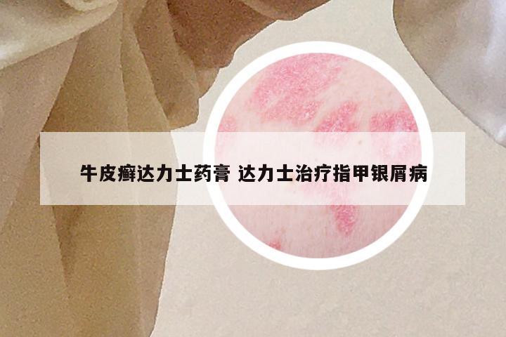 牛皮癣达力士药膏 达力士治疗指甲银屑病