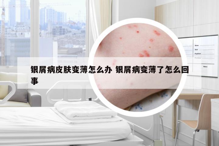 银屑病皮肤变薄怎么办 银屑病变薄了怎么回事