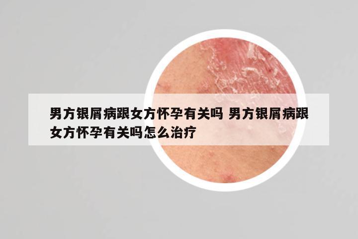 男方银屑病跟女方怀孕有关吗 男方银屑病跟女方怀孕有关吗怎么治疗