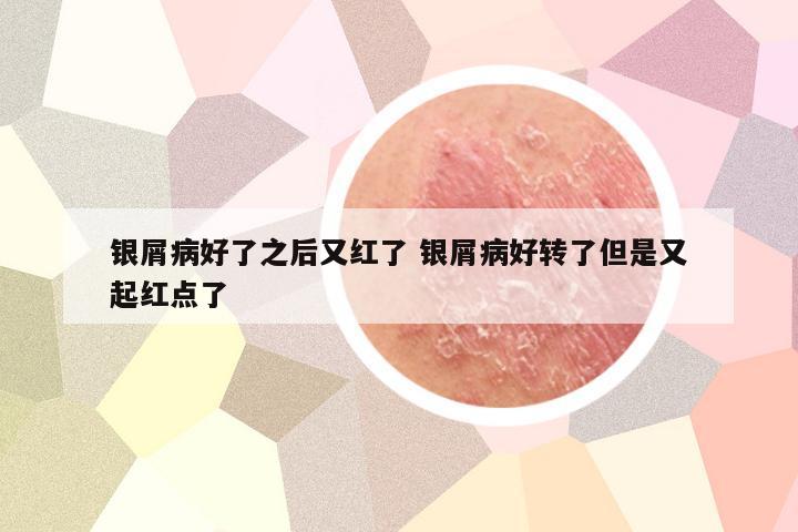 银屑病好了之后又红了 银屑病好转了但是又起红点了