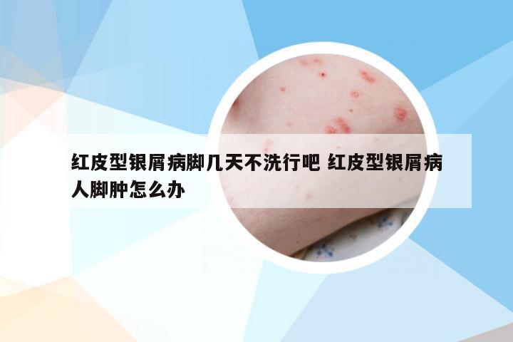 红皮型银屑病脚几天不洗行吧 红皮型银屑病人脚肿怎么办