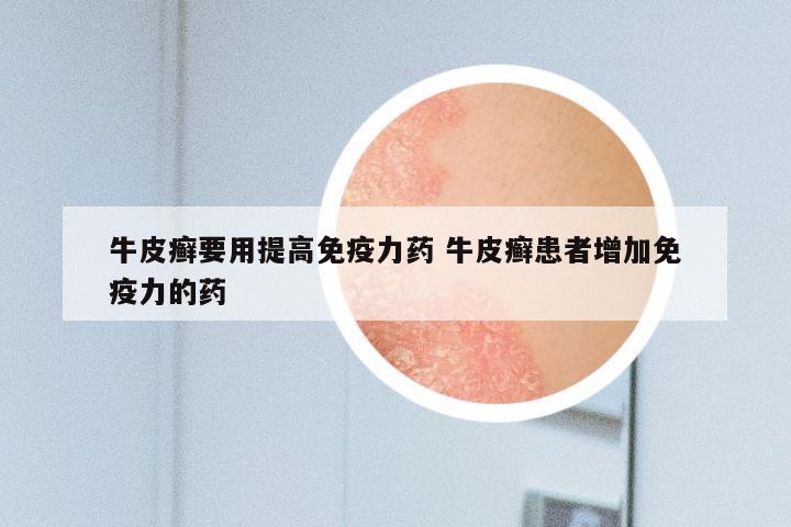 牛皮癣要用提高免疫力药 牛皮癣患者增加免疫力的药