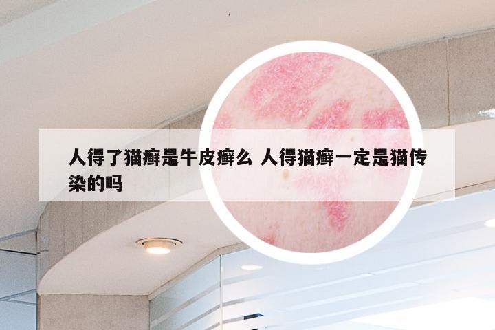 人得了猫癣是牛皮癣么 人得猫癣一定是猫传染的吗