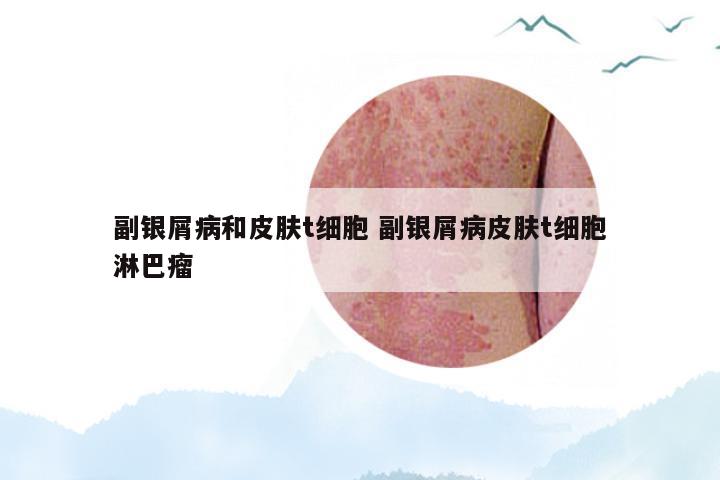 副银屑病和皮肤t细胞 副银屑病皮肤t细胞淋巴瘤