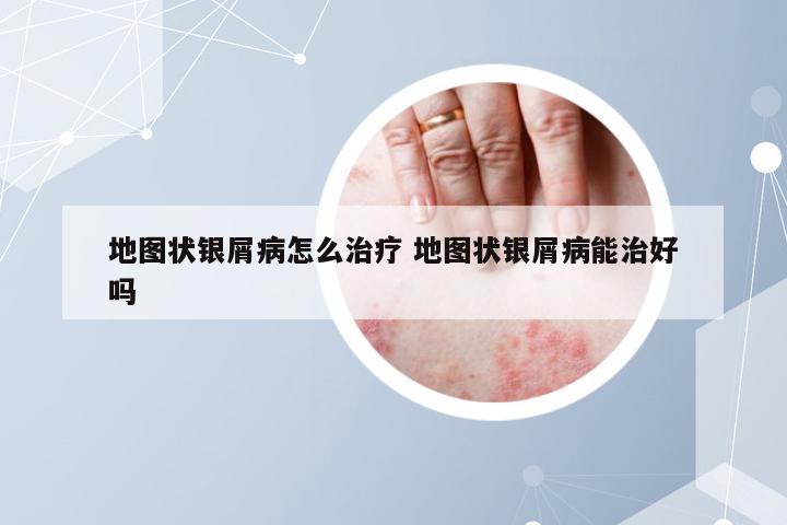 地图状银屑病怎么治疗 地图状银屑病能治好吗