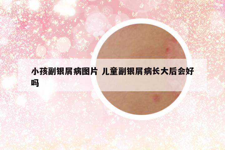 小孩副银屑病图片 儿童副银屑病长大后会好吗