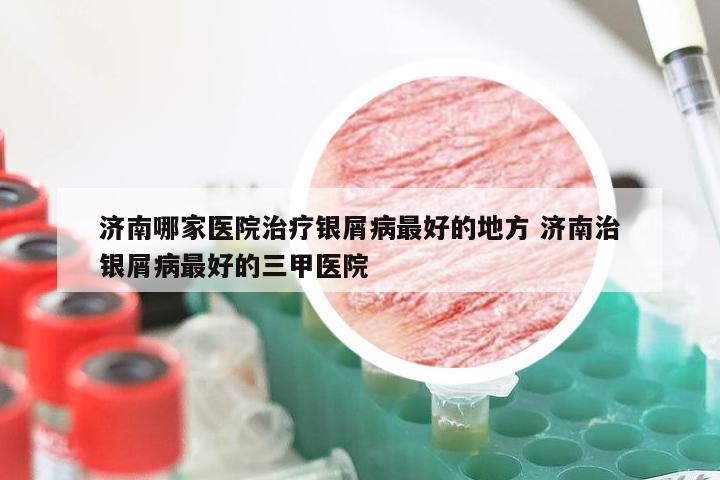 济南哪家医院治疗银屑病最好的地方 济南治银屑病最好的三甲医院