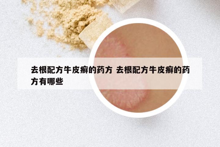 去根配方牛皮癣的药方 去根配方牛皮癣的药方有哪些