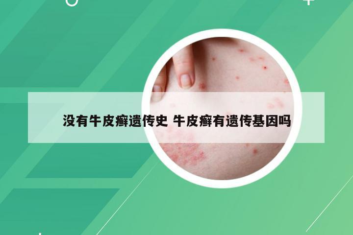 没有牛皮癣遗传史 牛皮癣有遗传基因吗