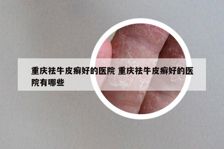 重庆祛牛皮癣好的医院 重庆祛牛皮癣好的医院有哪些