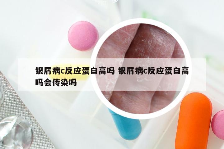 银屑病c反应蛋白高吗 银屑病c反应蛋白高吗会传染吗