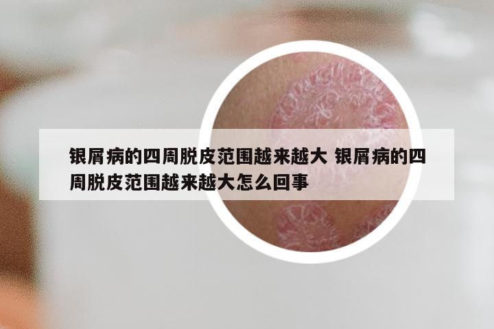 银屑病的四周脱皮范围越来越大 银屑病的四周脱皮范围越来越大怎么回事