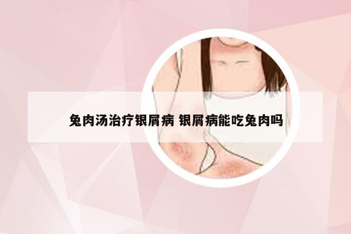 兔肉汤治疗银屑病 银屑病能吃兔肉吗