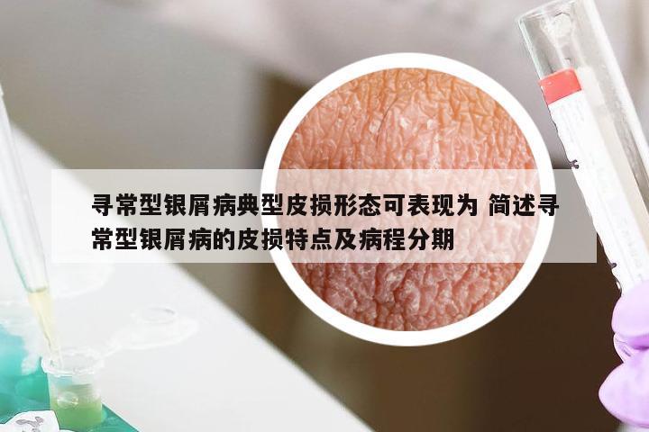 寻常型银屑病典型皮损形态可表现为 简述寻常型银屑病的皮损特点及病程分期