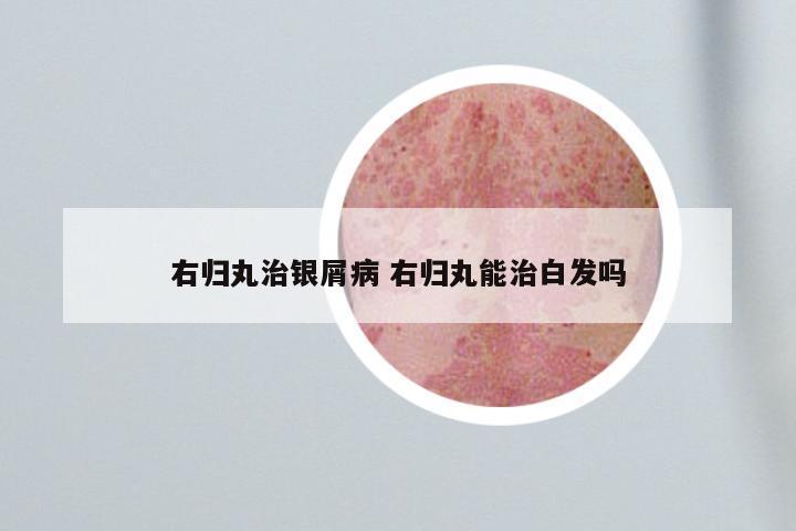 右归丸治银屑病 右归丸能治白发吗
