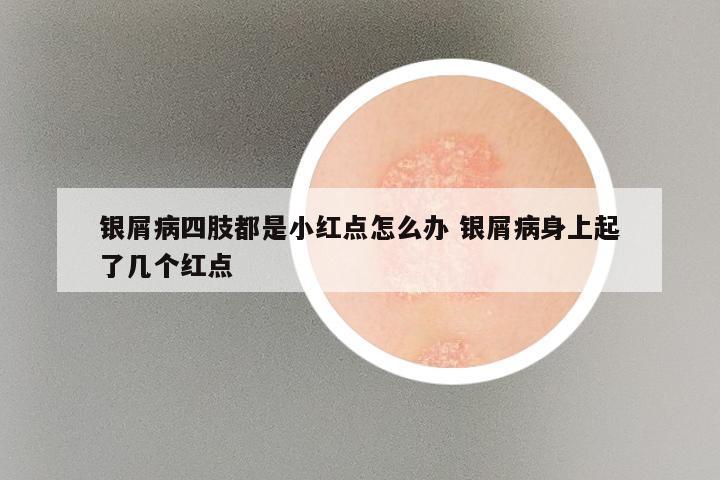 银屑病四肢都是小红点怎么办 银屑病身上起了几个红点