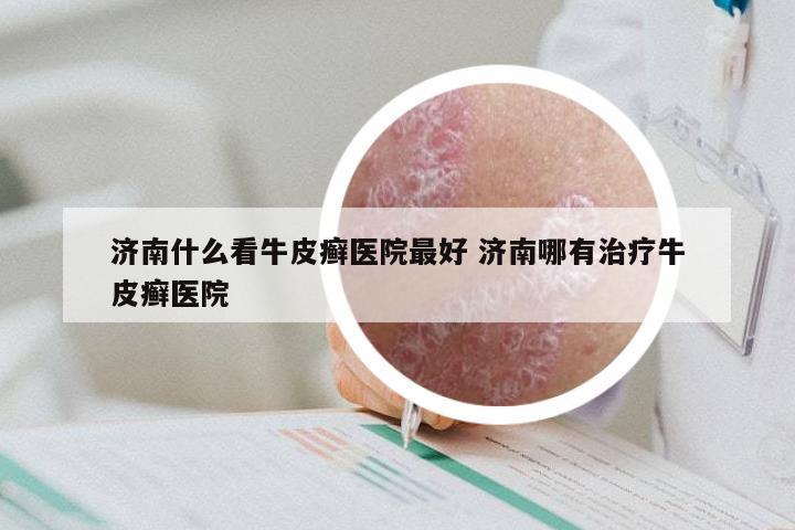 济南什么看牛皮癣医院最好 济南哪有治疗牛皮癣医院