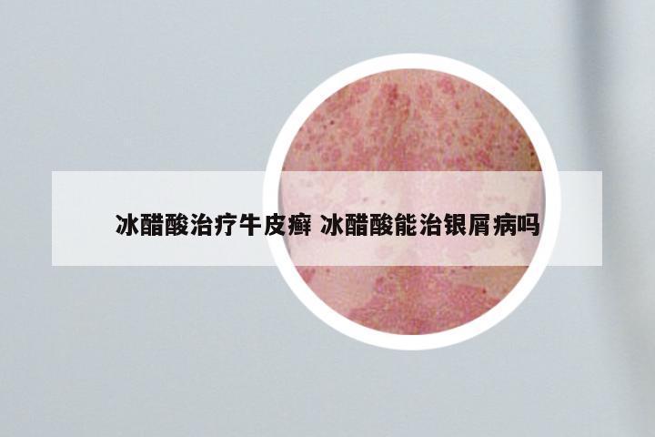 冰醋酸治疗牛皮癣 冰醋酸能治银屑病吗