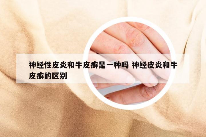 神经性皮炎和牛皮癣是一种吗 神经皮炎和牛皮癣的区别