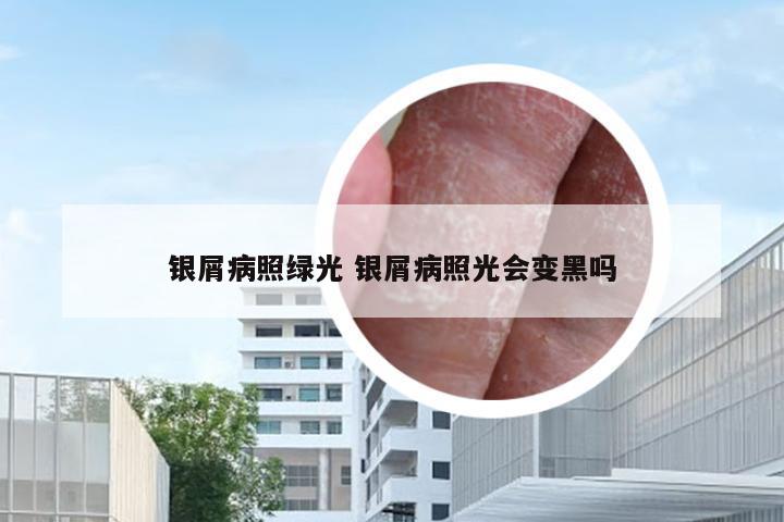 银屑病照绿光 银屑病照光会变黑吗