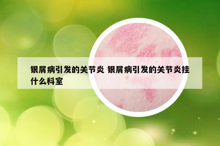 银屑病引发的关节炎 银屑病引发的关节炎挂什么科室