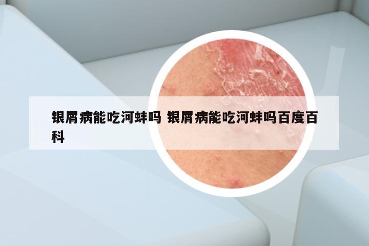 银屑病能吃河蚌吗 银屑病能吃河蚌吗百度百科