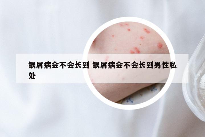 银屑病会不会长到 银屑病会不会长到男性私处