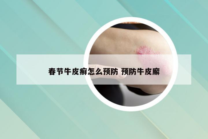 春节牛皮癣怎么预防 预防牛皮廨