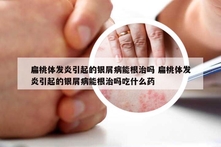 扁桃体发炎引起的银屑病能根治吗 扁桃体发炎引起的银屑病能根治吗吃什么药