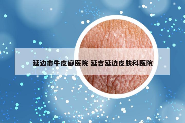延边市牛皮癣医院 延吉延边皮肤科医院