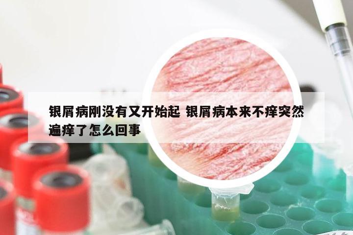 银屑病刚没有又开始起 银屑病本来不痒突然遍痒了怎么回事