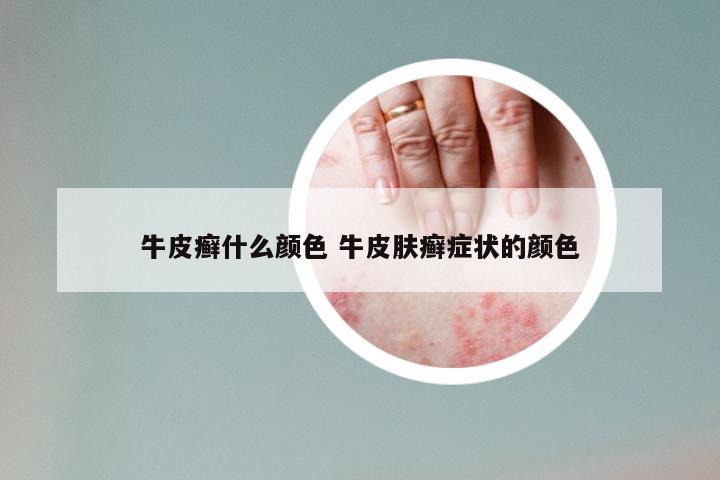 牛皮癣什么颜色 牛皮肤癣症状的颜色