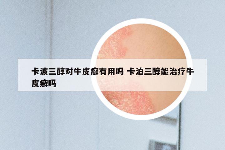 卡波三醇对牛皮癣有用吗 卡泊三醇能治疗牛皮癣吗