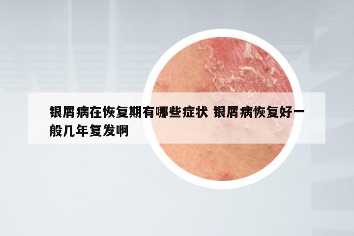 银屑病在恢复期有哪些症状 银屑病恢复好一般几年复发啊