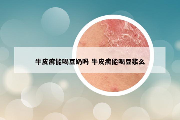 牛皮癣能喝豆奶吗 牛皮癣能喝豆浆么