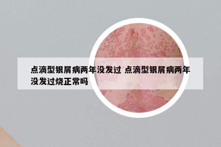 点滴型银屑病两年没发过 点滴型银屑病两年没发过烧正常吗