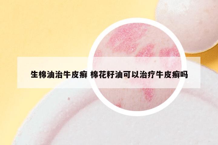 生棉油治牛皮癣 棉花籽油可以治疗牛皮癣吗