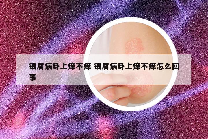 银屑病身上痒不痒 银屑病身上痒不痒怎么回事