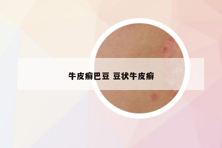 牛皮癣巴豆 豆状牛皮癣