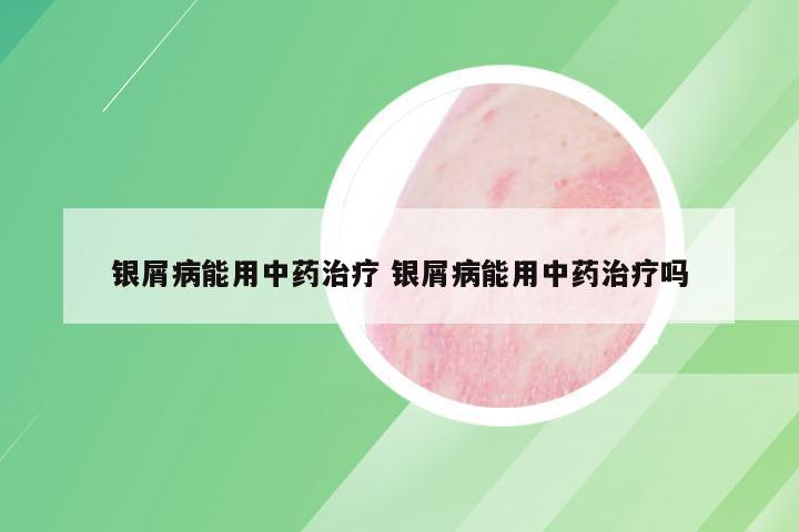 银屑病能用中药治疗 银屑病能用中药治疗吗