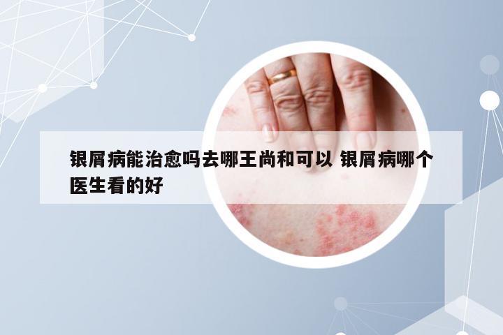 银屑病能治愈吗去哪王尚和可以 银屑病哪个医生看的好