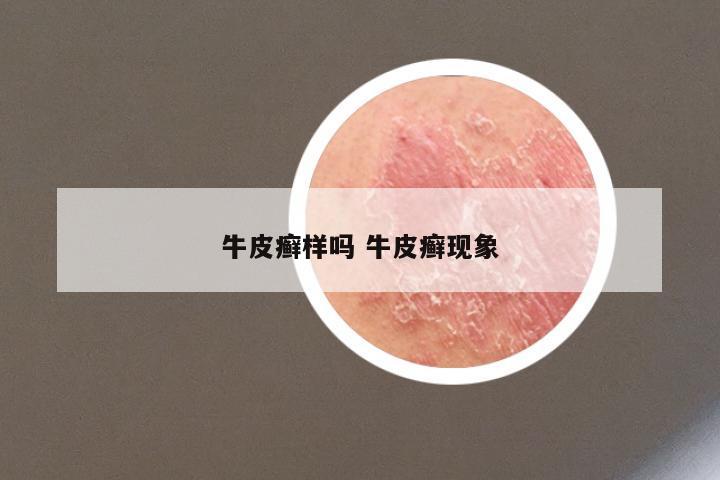 牛皮癣样吗 牛皮癣现象