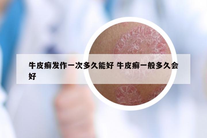 牛皮癣发作一次多久能好 牛皮癣一般多久会好